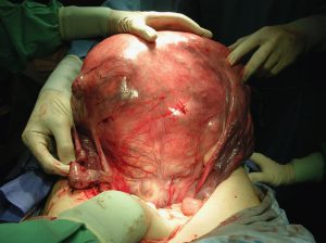 Sarcoma uterino