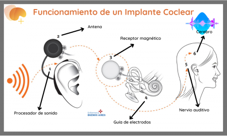 Implante coclear - Ventajas y desventajas
