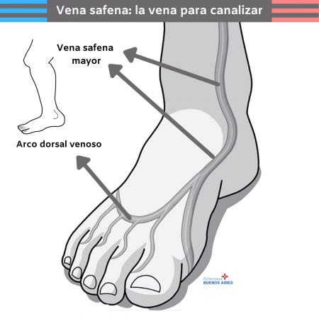 ¿Cómo colocar un catéter venoso en el pie?